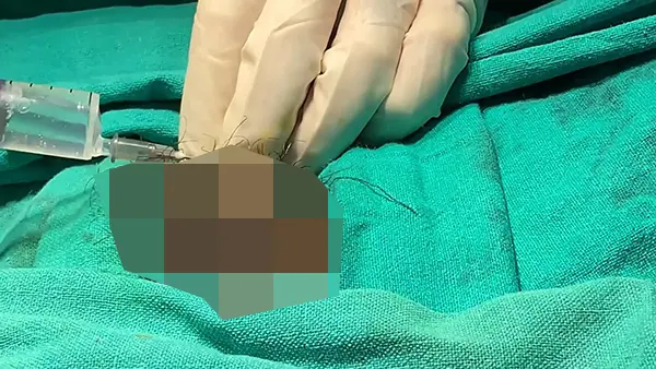 男人包皮环切术,几分钟即可露头不再包-02
