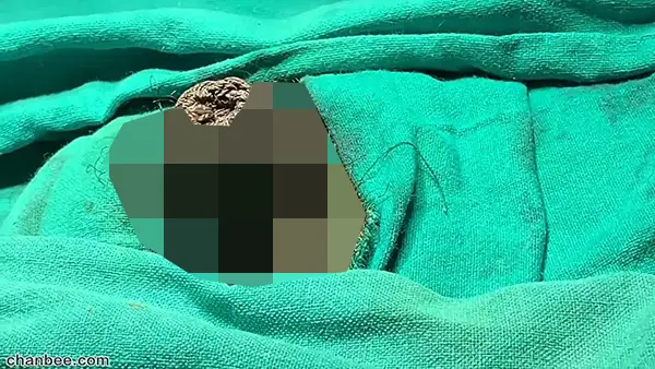 男人包皮环切术,几分钟即可露头不再包-03