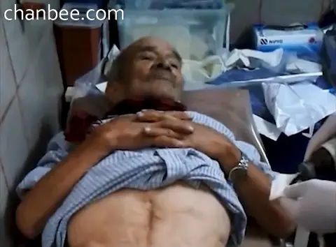 医生给大阴囊老伯更换导尿管
