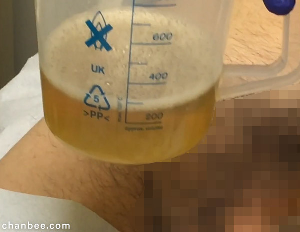 老年男性阴囊积水抽取过程-0004
