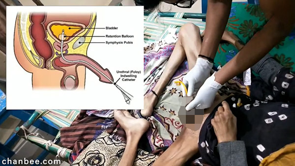 家庭医生给骨瘦如柴的老伯安插导尿管-0001