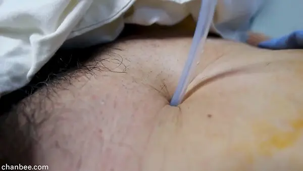 这样的安插导尿管看着都痛-0008