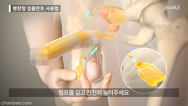 韩国中老年假体植入助勃器测试_02