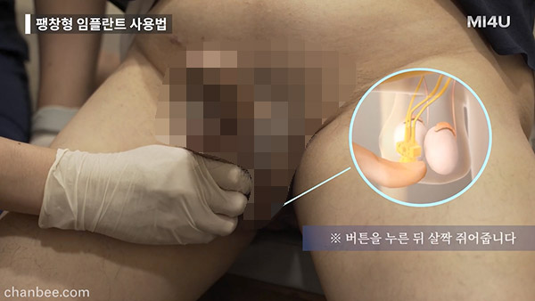 韩国中老年假体植入助勃器测试_03