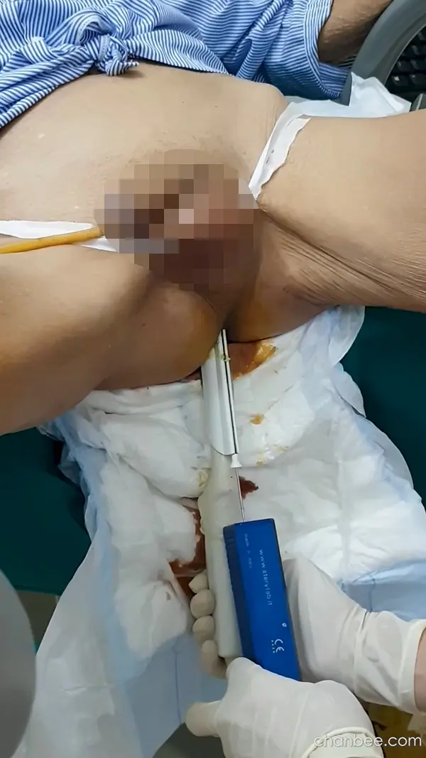 老年男性前列腺仪器检查-0006