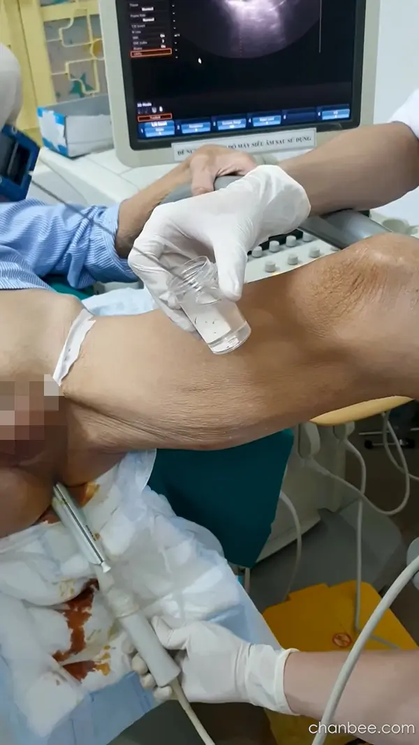 老年男性前列腺仪器检查-0005
