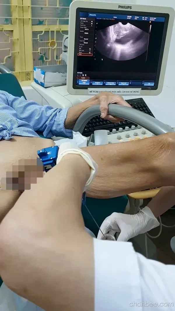 老年男性前列腺仪器检查-0008