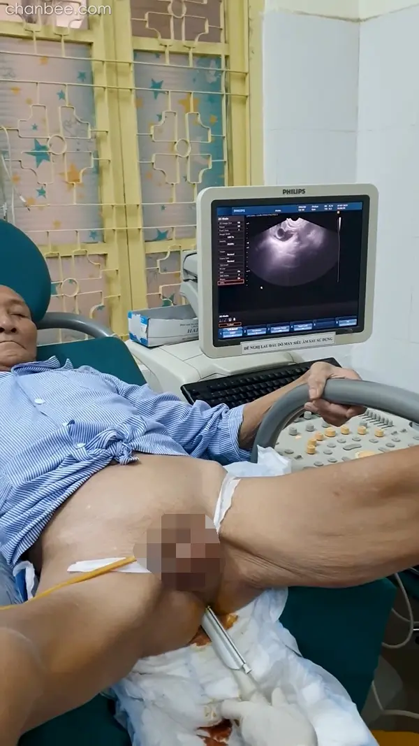 老年男性前列腺仪器检查-0003