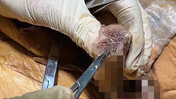 男性阴茎海绵体血管神经解刨讲解