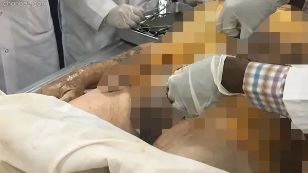临床学生观摩导师用老年大体老师解刨讲解睾丸结构-0006