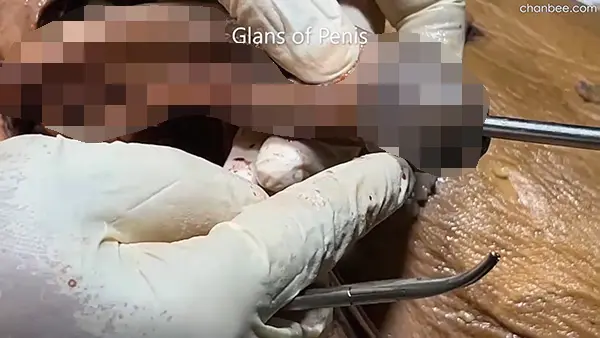 男性阴茎海绵体血管神经解刨讲解-0008