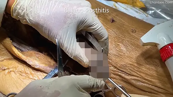 男性阴茎海绵体血管神经解刨讲解-0009