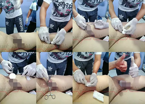 六旬胖叔做包皮环切-0002
