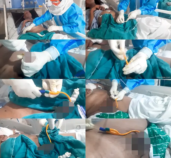 护士帮病床男性老年人把尿套改成导尿管-0002