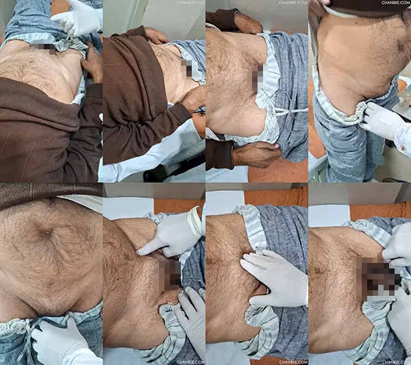 主治医生给病床老叔检查疝气状况-2