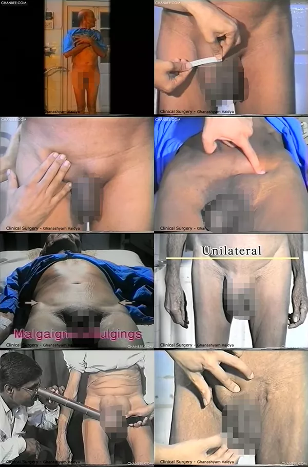 腹股沟阴囊肿胀的检查-0002