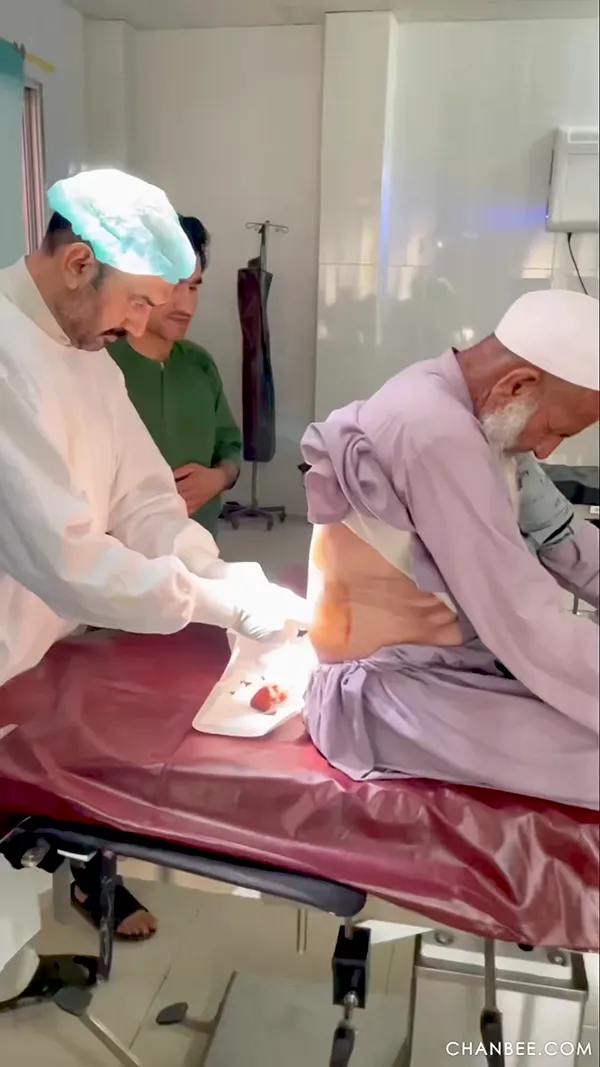 男性腹股沟疝网片修补手术