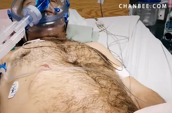 男性紧急膀胱造口导尿术
