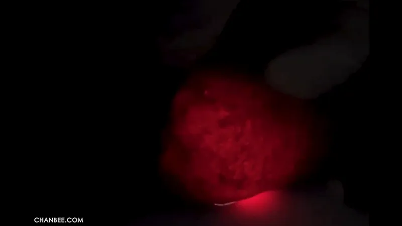 外科男性阴囊鞘膜积液透照检查